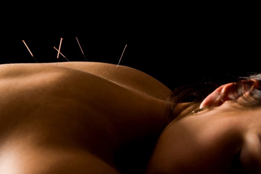 //chirocarewellnessclinic.com/wp-content/uploads/2016/06/acupuncture-3.jpg